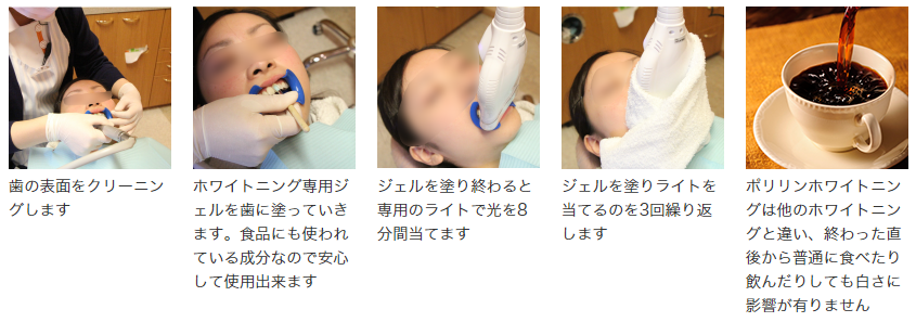ホワイトニング